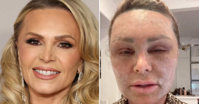 Tamra Judge RHOC plastic surgery