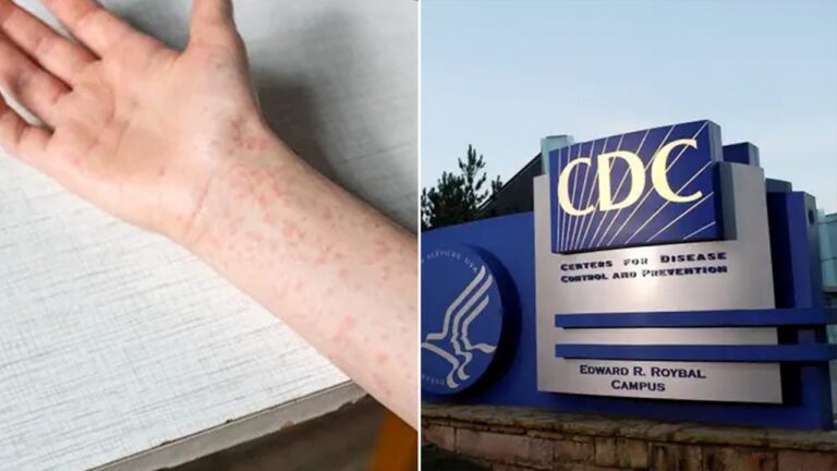 cdc measles
